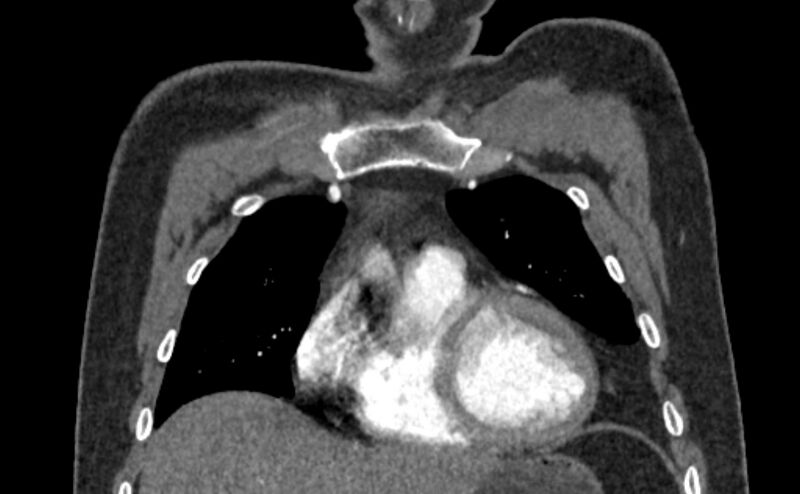 File:Coarctation of the aorta (Radiopaedia 53363-59343 C 16).jpg