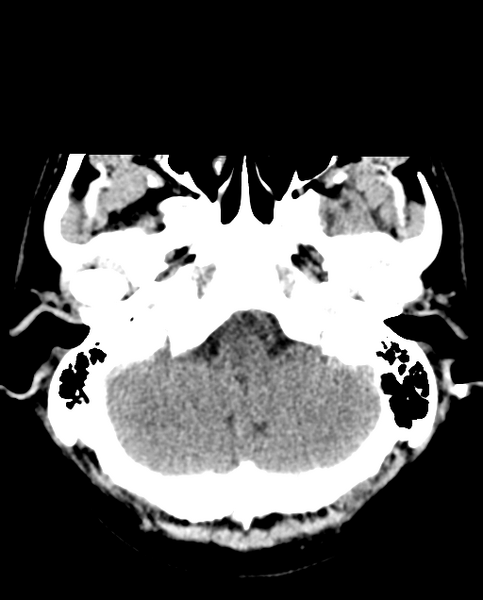 File:Colloid cyst of the third ventricle (Radiopaedia 86571-102661 Axial non-contrast 8).png
