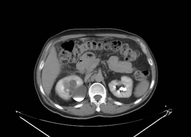 File:Colon cancer mimicking renal cell carcinoma (Radiopaedia 28986-29335 Axial C+ delayed 25).jpg