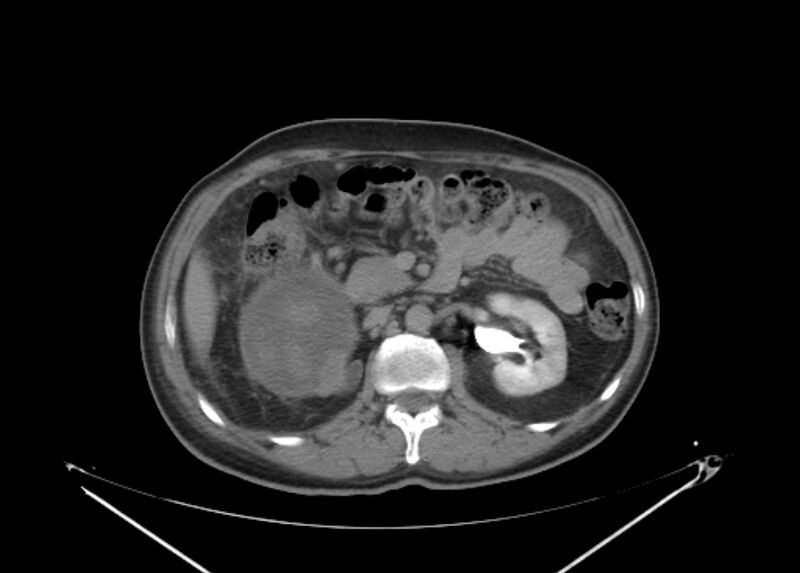 File:Colon cancer mimicking renal cell carcinoma (Radiopaedia 28986-29335 Axial C+ delayed 30).jpg