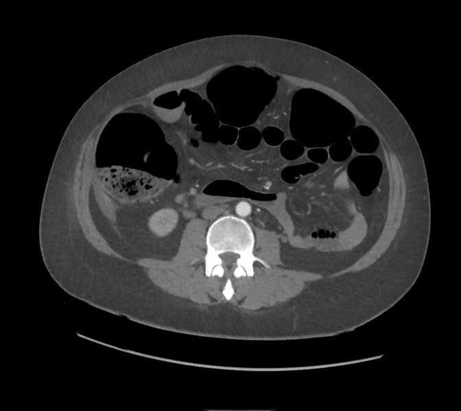 File:Colonic pseudo-obstruction (Radiopaedia 79752-92980 A 101).png