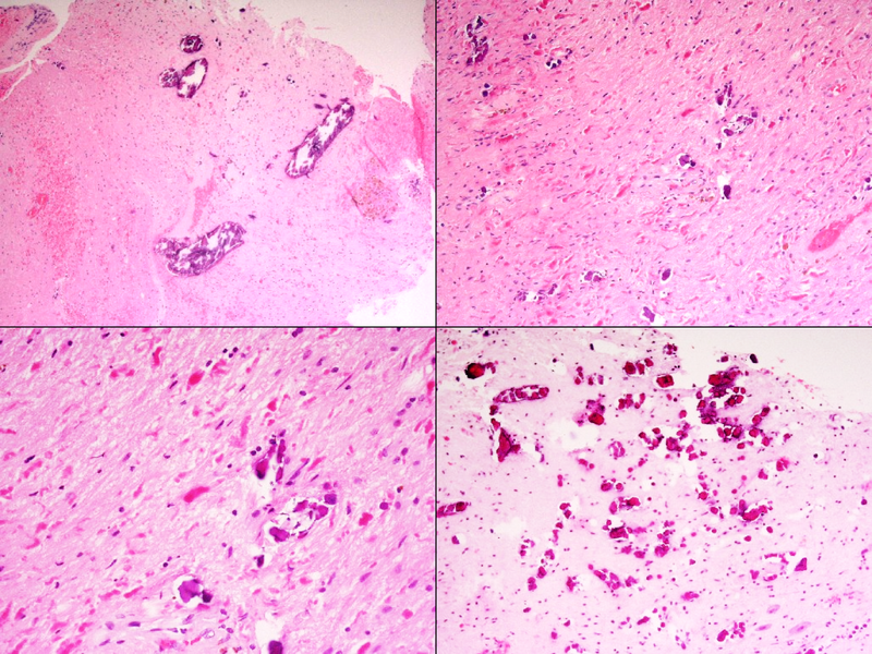 File:Leukoencephalopathy with calcifications and cysts (histology) (Radiopaedia 60264).png