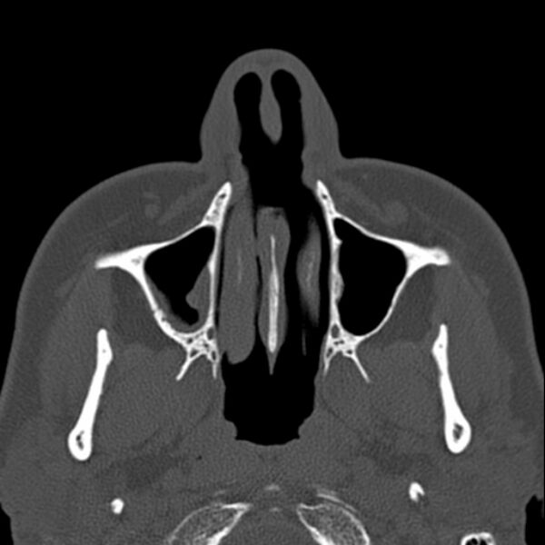 File:Nasal septal perforation (Radiopaedia 25030-25289 Axial bone window 8).jpg