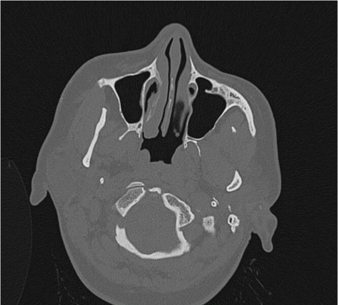 File:Nasolabial cyst (Radiopaedia 25322-25580 Axial bone window 10).jpg