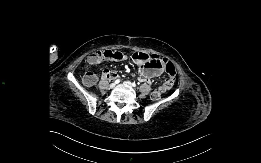 Neo-terminal ileal stricture (Crohn disease) (Radiopaedia 33790-34948 A 303).jpg