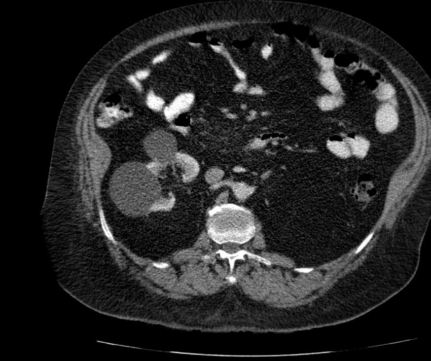 Nephroptosis with inguinal hernia containing perirenal fat (Radiopaedia 56632-63391 C 149).jpg