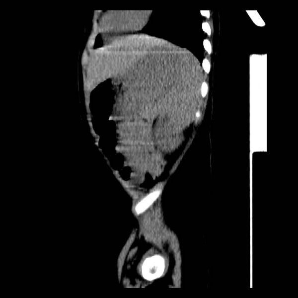 File:Neuroblastoma with skull metastases (Radiopaedia 30326-30960 B 37).jpg