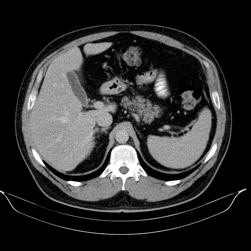 Neuroendocrine tumor of head of pancreas (Radiopaedia 57538-64502 D 24).jpg