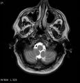 Neurosarcoidosis (Radiopaedia 10930-17204 Axial T2 2).jpg