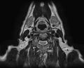 Non-Hodgkin lymphoma - parotid gland (Radiopaedia 71531-81890 Axial T2 3).jpg