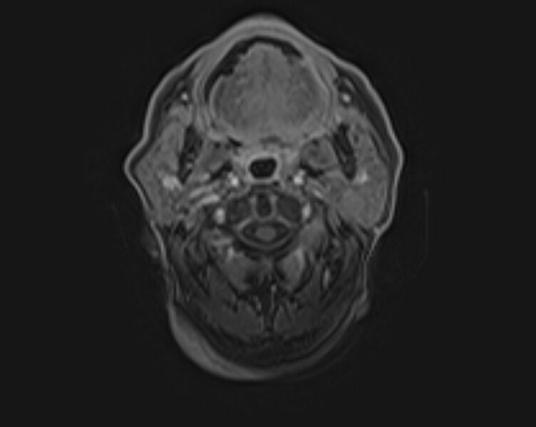 File:Non-Hodgkin lymphoma - parotid gland (Radiopaedia 71531-81890 E 12).jpg