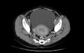 Non-puerperal uterine inversion (Radiopaedia 78343-91094 A 23).jpg
