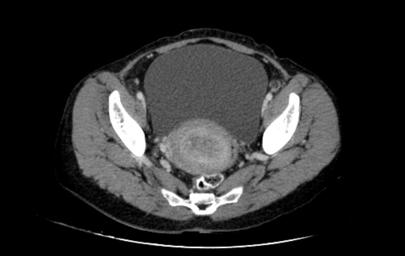 File:Non-puerperal uterine inversion (Radiopaedia 78343-91094 A 23).jpg