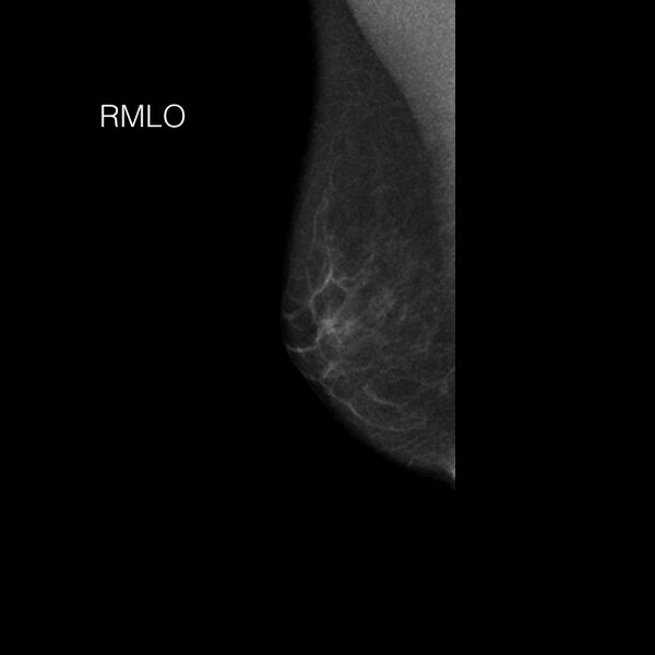 File:Normal breast mammography (tomosynthesis) and ultrasound (Radiopaedia 65325-74355 MLO 1).jpeg