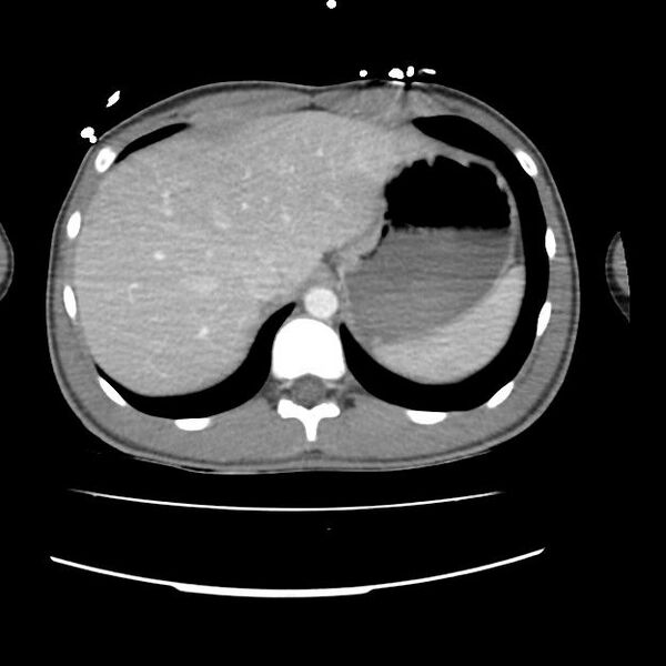 File:Normal dual-phase trauma CT chest,abdomen and pelvis (Radiopaedia 48092-52899 A 50).jpg