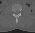 Normal lumbar spine CT (Radiopaedia 46533-50986 Axial bone window 38).png