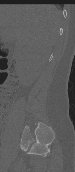 File:Normal lumbosacral CT (Radiopaedia 37923-39867 Sagittal bone window 87).png