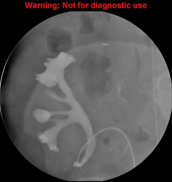 File:Normal retrograde pyelography of a native and transplant kidney (Radiopaedia 40480-43054 Transplant kidney 19).jpg