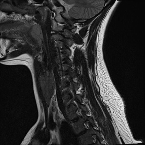 File:Normal trauma cervical spine MRI (Radiopaedia 32130-33071 Sagittal T2 12).jpg
