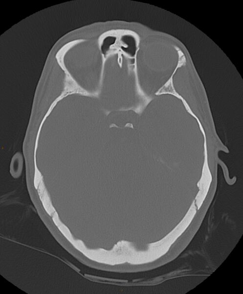 File:Occipital condyle fracture (Radiopaedia 61165-69056 Axial bone window 15).jpg