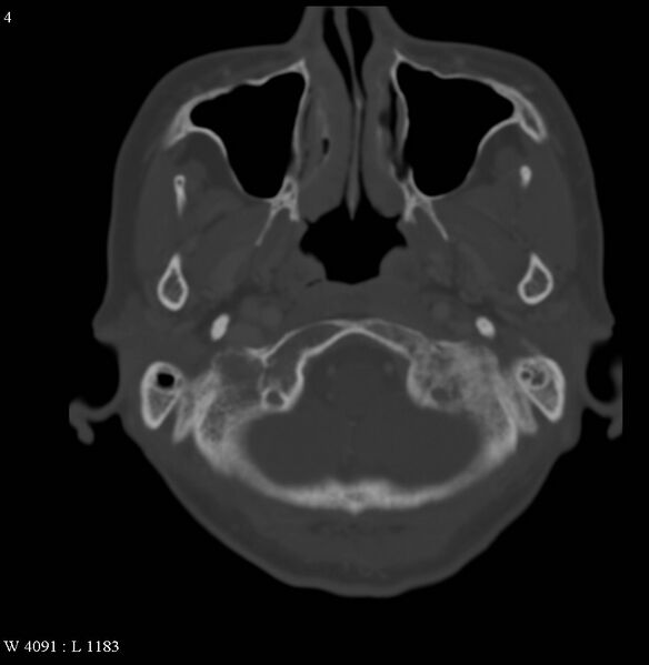 File:Occipital condyle metastasis - into mastoid (Radiopaedia 5424-7177 Axial bone window 4).jpg