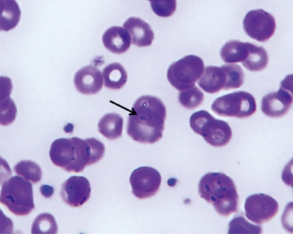 Peripheral blood smear showing a ring form of Plasmodium falciparum