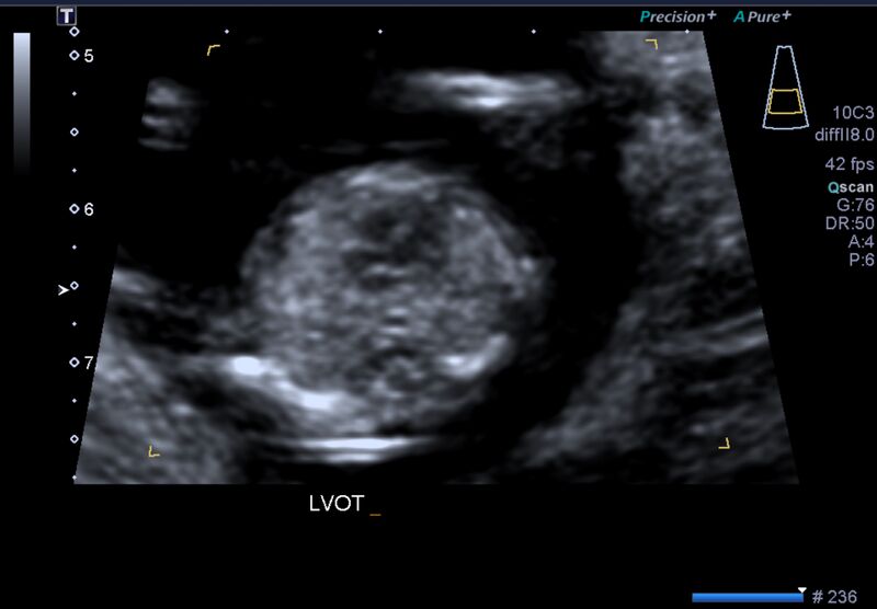 File:1st trimester nuchal-morphology ultrasound (Radiopaedia 44706-48477 General anatomy and NT 21).jpg