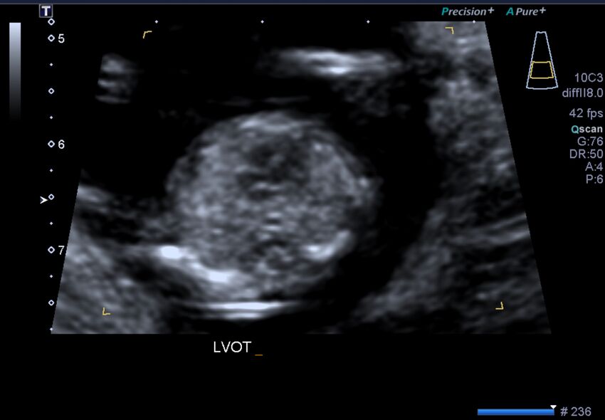 1st trimester nuchal-morphology ultrasound (Radiopaedia 44706-48477 General anatomy and NT 21).jpg