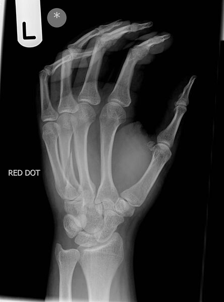 File:4th metacarpal fracture (Radiopaedia 7314-8223 Oblique 1).jpg
