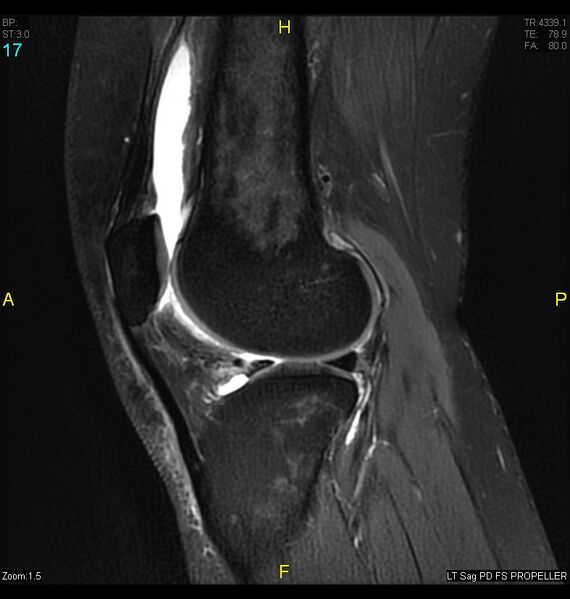 File:ACL mucoid degeration with cystic changes (Radiopaedia 48428-53341 Sagittal PD fat sat 15).jpg