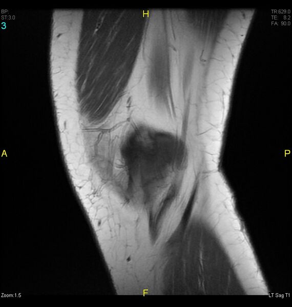 File:ACL mucoid degeration with cystic changes (Radiopaedia 48428-53341 Sagittal T1 1).jpg