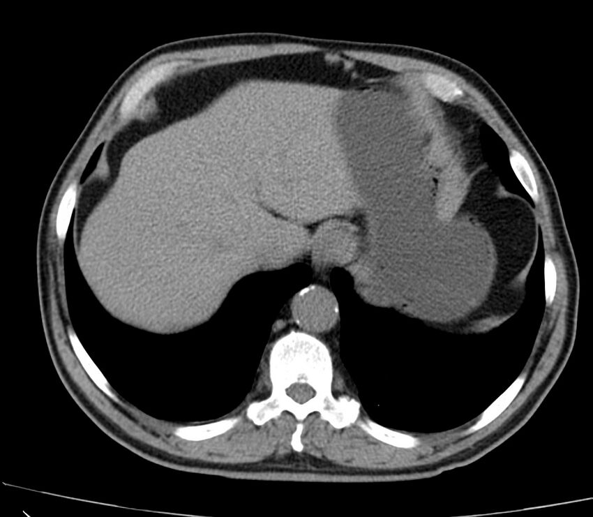 Abdominal aortic aneurysm (Radiopaedia 22421-22458 non-contrast 7).jpg