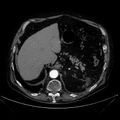 Abdominal aortic aneurysm (Radiopaedia 25855-26001 Axial C+ arterial phase 33).jpg
