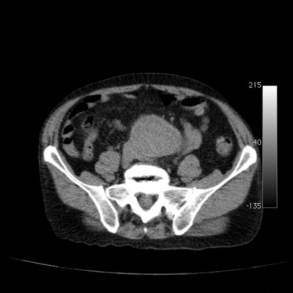 File:Abdominal aortic aneurysm (Radiopaedia 29248-29660 Axial non-contrast 40).jpg