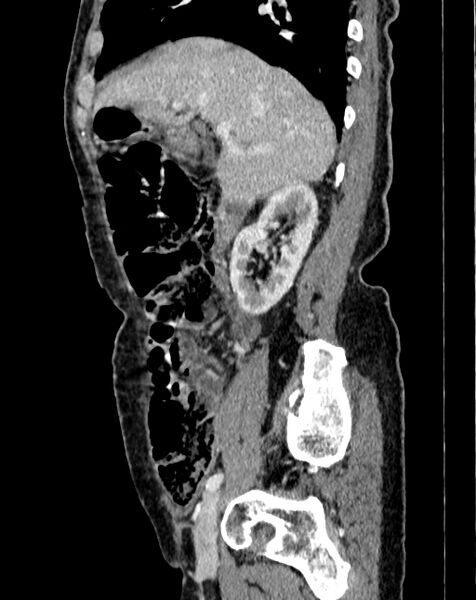 File:Abdominal aortic aneurysm (Radiopaedia 83581-98689 Sagittal C+ portal venous phase 4).jpg
