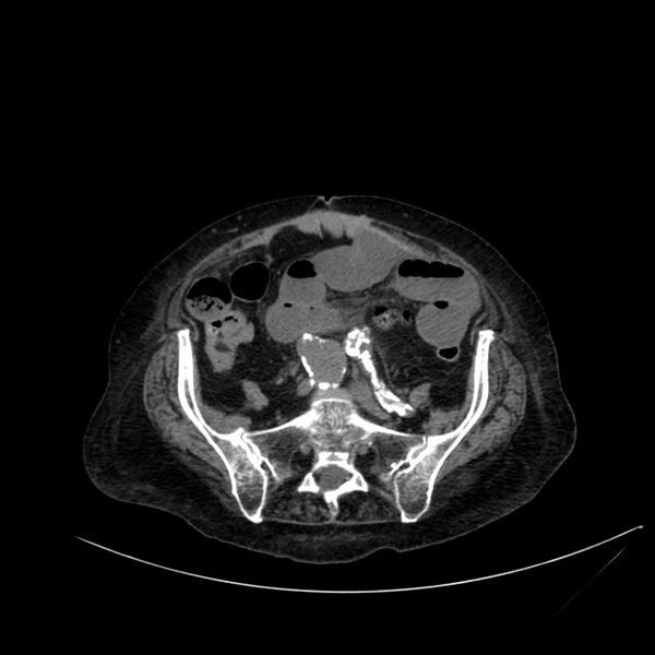 File:Abdominal aortic aneurysm - impending rupture (Radiopaedia 19233-19246 Axial non-contrast 91).jpg