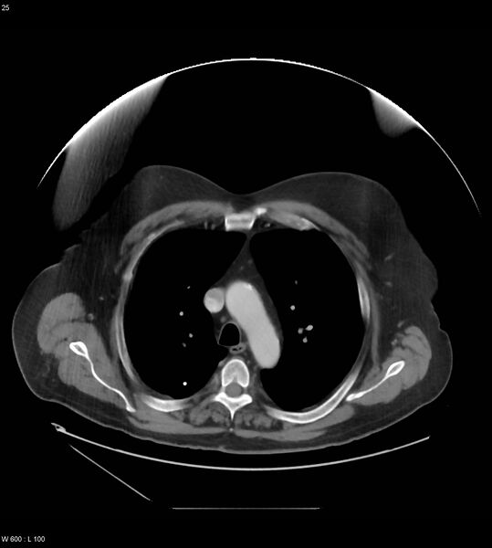 File:Abdominal aortic aneurysm with intramural hematoma then rupture (Radiopaedia 50278-55631 Axial C+ arterial phase 16).jpg
