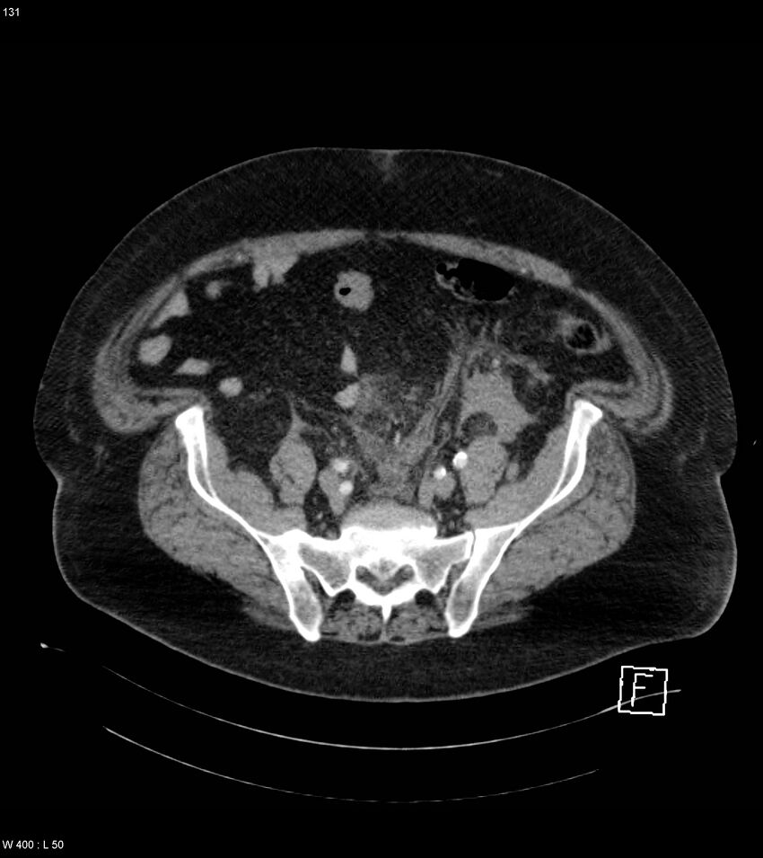 Abdominal aortic aneurysm with intramural hematoma then rupture (Radiopaedia 50278-55632 Axial C+ arterial phase 130).jpg