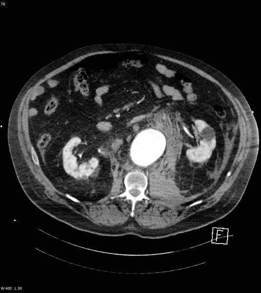 File:Abdominal aortic aneurysm with intramural hematoma then rupture (Radiopaedia 50278-55632 Axial C+ arterial phase 75).jpg