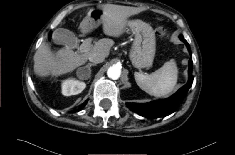 File:Abdominal aortic interposition tube graft and aneurysm thrombosis (Radiopaedia 71438-81857 Axial C+ arterial phase 10).jpg