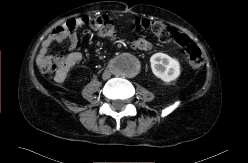 File:Abdominal aortic interposition tube graft and aneurysm thrombosis (Radiopaedia 71438-81857 Axial C+ arterial phase 107).jpg