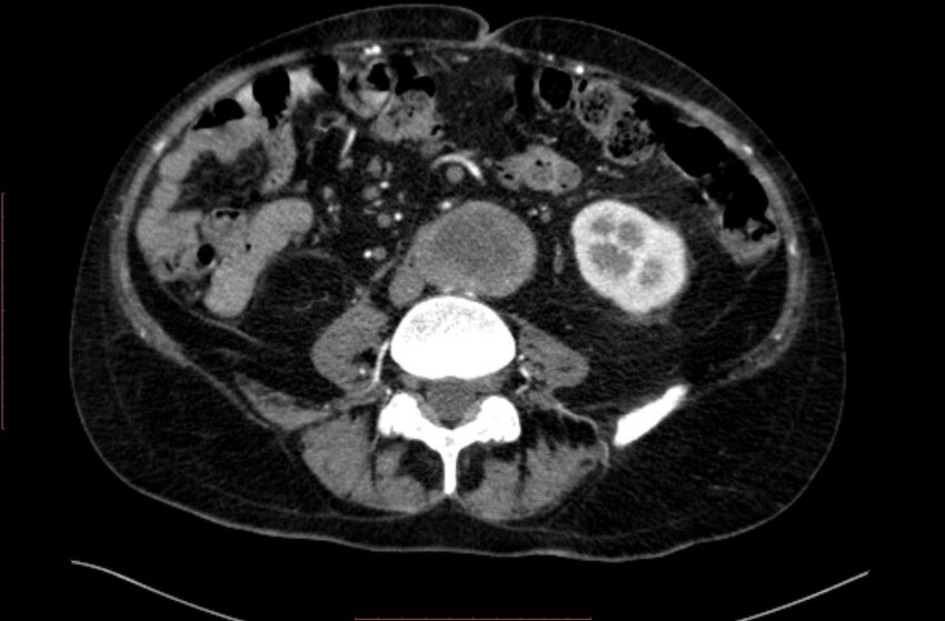 Abdominal aortic interposition tube graft and aneurysm thrombosis (Radiopaedia 71438-81857 Axial C+ arterial phase 107).jpg