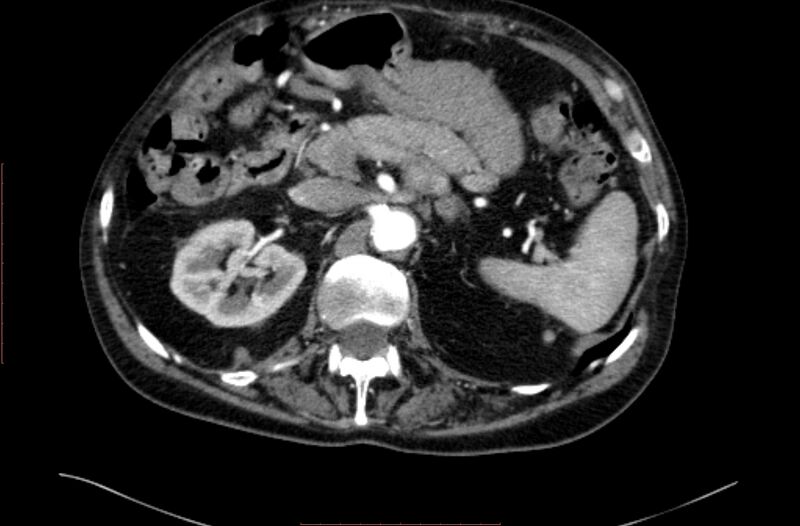 File:Abdominal aortic interposition tube graft and aneurysm thrombosis (Radiopaedia 71438-81857 Axial C+ arterial phase 29).jpg