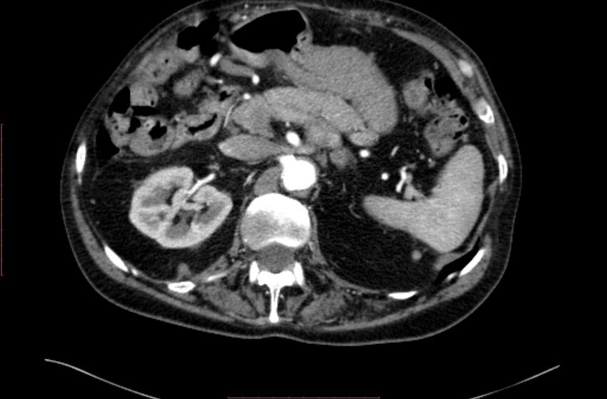 Abdominal aortic interposition tube graft and aneurysm thrombosis (Radiopaedia 71438-81857 Axial C+ arterial phase 29).jpg