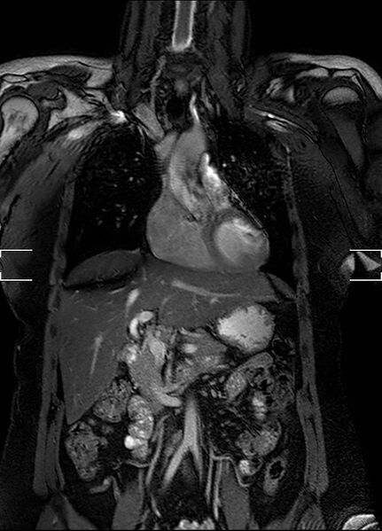 File:Aberrant right subclavian artery with background Takayasu arteritis (Radiopaedia 21423-21363 Coronal MRA 6).jpg