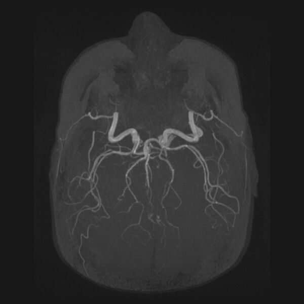 File:Accessory middle cerebral artery and ICA aneurysm (Radiopaedia 22656-22674 B 28).jpg