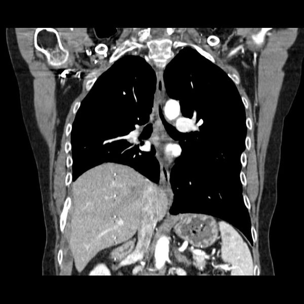 File:Acquired adrenal hyperplasia - due to thymic carcinoid tumor (Radiopaedia 21269-21184 C 3).jpg
