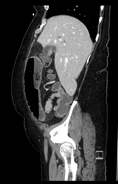 File:Active Crohn disease (Radiopaedia 59394-66750 Sagittal C+ portal venous phase 45).jpg