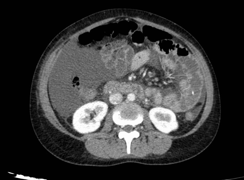 File:Acute Budd-Chiari syndrome (Radiopaedia 60858-68638 Axial C+ portal venous phase 148).jpg