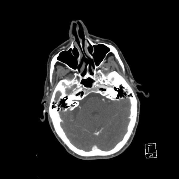File:Acute ICA ischemic penumbra due to high-grade CCA stenosis (CT perfusion) (Radiopaedia 72038-82530 Axial C+ arterial phase 15).jpg
